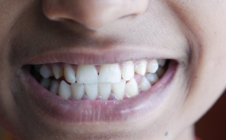 Kenali Tanda Gusi Berdarah dan Hubungannya dengan Kesehatan Tubuh Anda