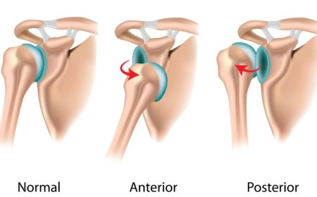 Dislokasi Bahu Berulang Bahaya Tersembunyi yang Mengancam Karier Atlet dan Cara Membangun Kembali Kekuatan Anda