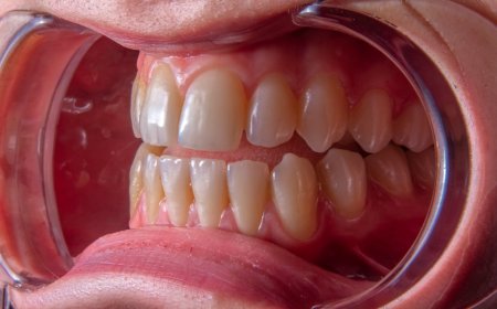 Pentingnya Scaling Gigi untuk Cegah Peradangan yang Berbahaya bagi Jantung