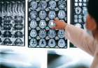 Puasa Intermiten Baik untuk Otak? Manfaat Kognitif dan Neuroproteksi Terungkap